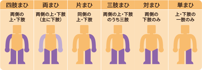 表：障害部位別のタイプ