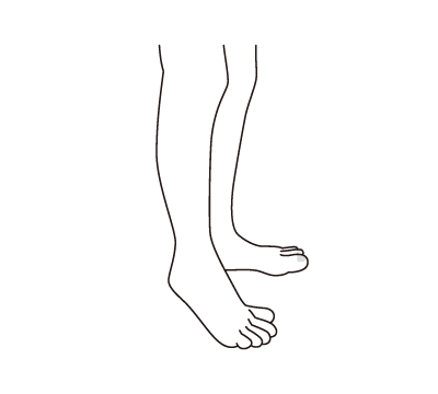 図：尖足